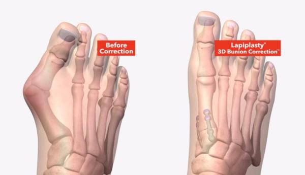 Lapiplasty