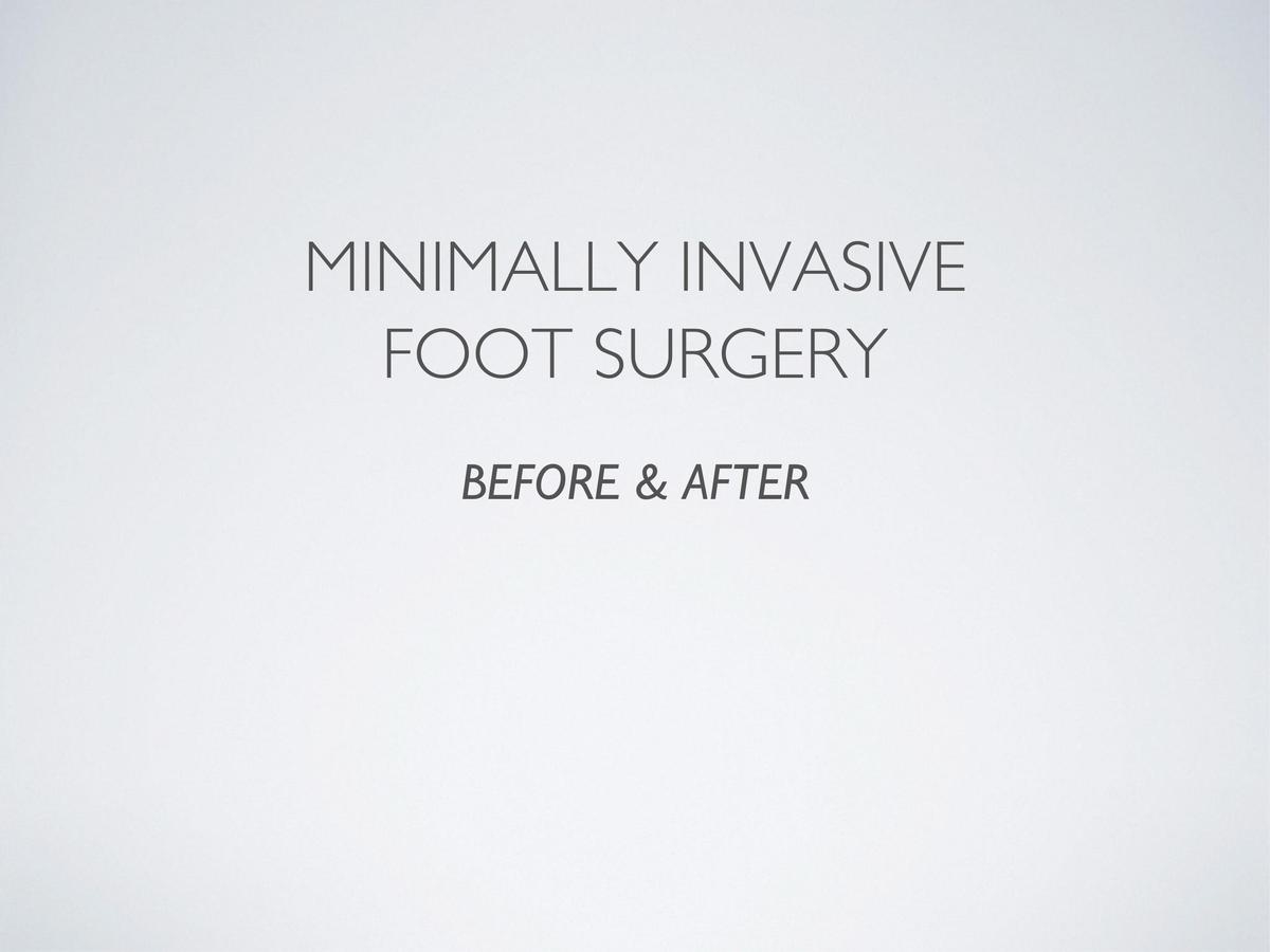 Minimally Invasive Foot Surgery Before & After Photos