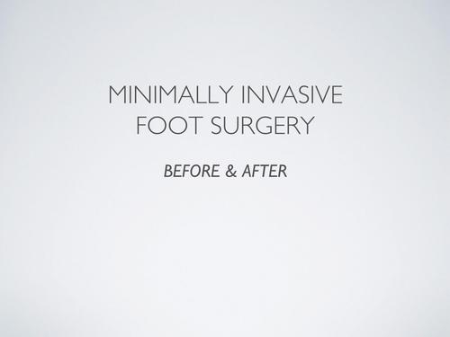 Minimally Invasive Foot Surgery Before & After